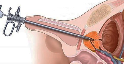 Endourology