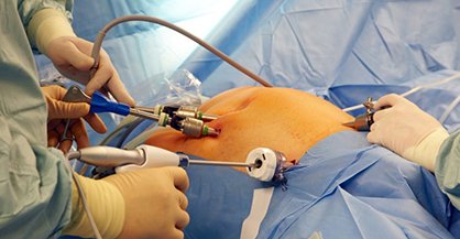 laparoscopic-urology